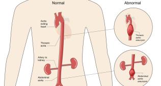 Know about Thoracic Aortic Dissection - Dr. Ritwick Raj Bhuyan
