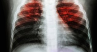 Tuberculosis is in the air - Dr. Avi Kumar