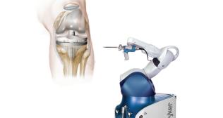 Robotic Knee Replacement