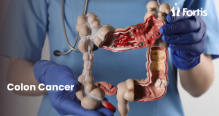 Best Colon Cancer Treatment in Mumbai
