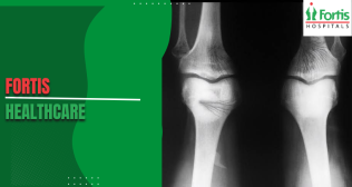 Understanding Ewing Sarcoma Pain