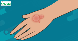 दाद (Ringworm) क्या है