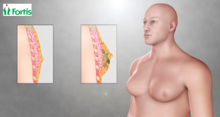 पुरुषों में बढ़े हुए स्तन - Gynecomastia