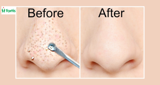 blackheads removal tips hindi
