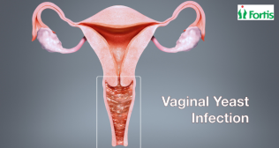 योनि यीस्ट संक्रमण (Vaginal Yeast Infection)