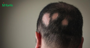 पुरुषों में बालों का झड़ना (Alopecia)