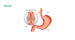 Esophagus Cancer