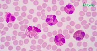 High Eosinophils