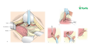 Urogenital Fistula After Hysterectomy