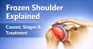 SEO METADATA (Internal — Remove Before Publishing) SEO Title: Frozen Shoulder Explained | Causes, Stages & Treatment Guide Meta Description: Frozen shoulder (adhesive capsulitis) causes, 3 stages, diabetes link & treatments from physiotherapy to arthroscopic release. Expert shoulder care in Tricity, Punjab. Focus Keywords: frozen shoulder, adhesive capsulitis, frozen shoulder treatment, shoulder stiffness, frozen shoulder causes, frozen shoulder and diabetes, shoulder pain at night, frozen shoulder speciali