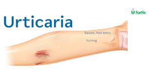 पित्ती (Urticaria) 