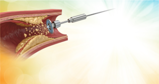 Understanding the Role of Rotablators