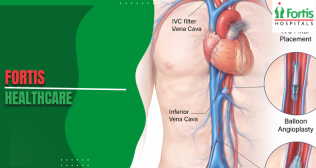 Inferior Vena Cava Procedures