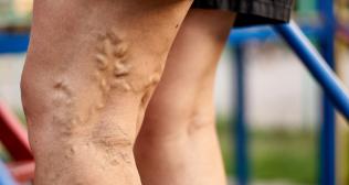 Varicose viens