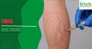 Post Pregnancy Varicose Veins 