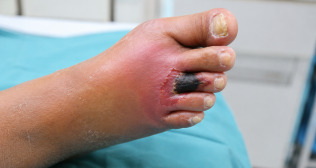 Diabetic Foot Infections