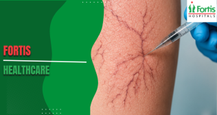 Sclerotherapy for Spider Veins