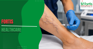 Foam Sclerotherapy 