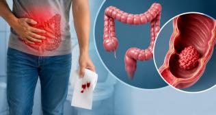 Blood in Stool: When Is It a Warning Sign of GI Cancer? - Dr Pradeep Jain