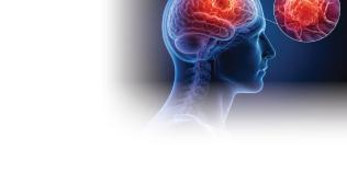 Brain Tumour treatment in Noida