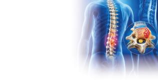 Spine tumour hospital in noida