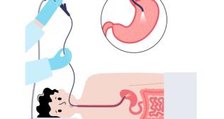 PEG Tube Placement-When Is It Needed and How Is It Done
