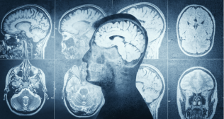 Post-Op Protocols That Drive Better Outcomes After Endoscopic Brain Surgery