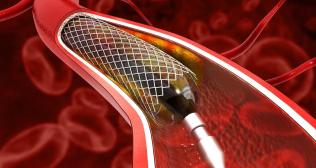 Understanding Angioplasty - Restoring Cardiovascular Health through Minimally Invasive Intervention