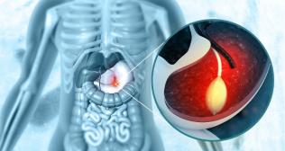 What Happens During a Therapeutic Polypectomy