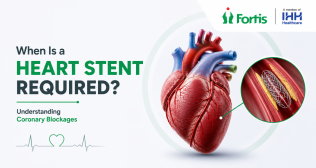 When Is a Heart Stent Required and Understanding Coronary Blockages
