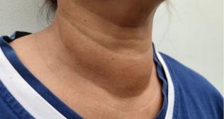 Why Is My Neck Swelling Getting Bigger