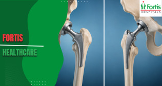 Posterior vs Direct Anterior