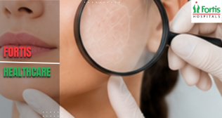 Best Dermatologist in Chandigarh