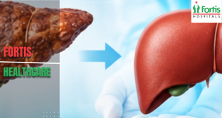 Liver Transplant