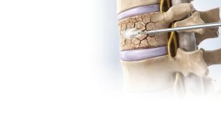 Vertebroplasty for Back Pain