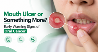 Mouth Ulcer or Something More? Early Warning Signs of Oral Cancer