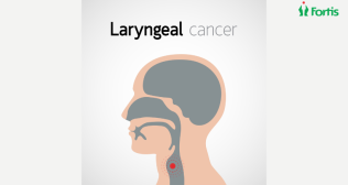 Laryngeal Cancer