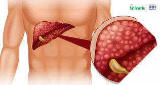 Gallbladder Polyps
