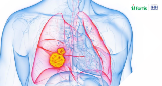 Lung Nodule