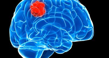 Brain Tumour