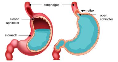 Gastroesophageal 