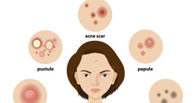what is acne