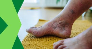 Diabetic Foot Management