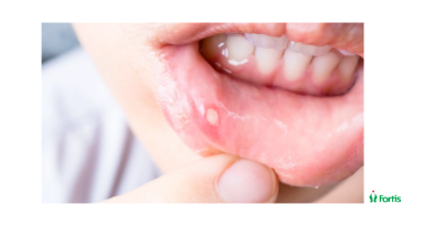 Common Cold Sore Triggers