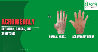 Acromegaly