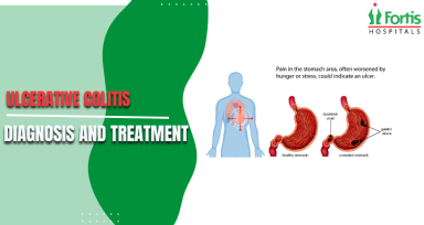 Ulcerative Colitis