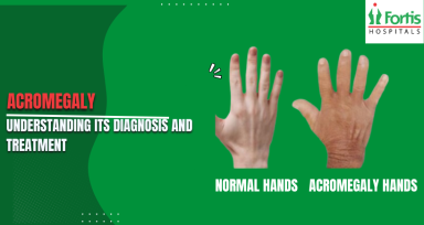 Acromegaly