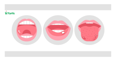 Canker Sores