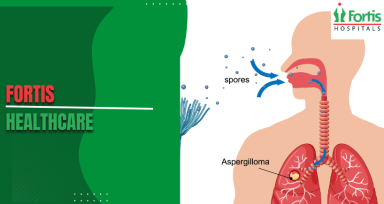 Olfactory Neuroblastoma