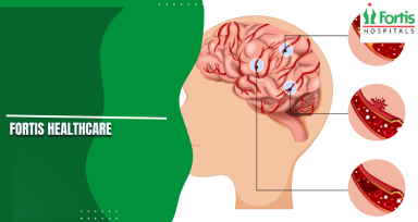Transient Ischemic Attack